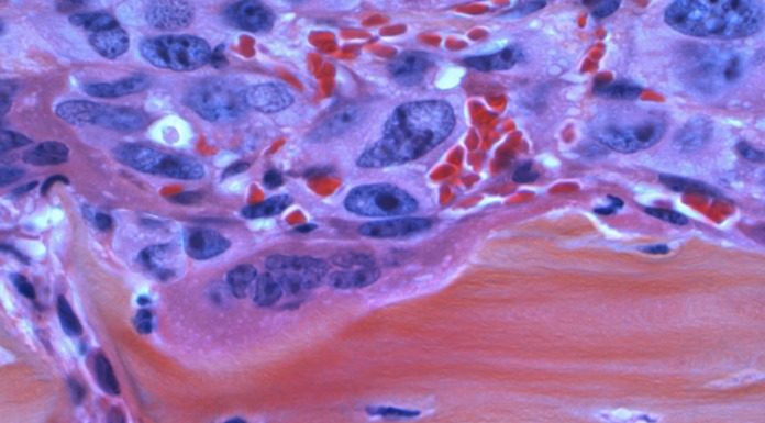 Η αιτία του καρκίνου ανακαλύφθηκε από τον Otto Heinrich Warburg το 1923 Η αιτία του καρκίνου ανακαλύφθηκε από τον Otto Heinrich Warburg το 1923