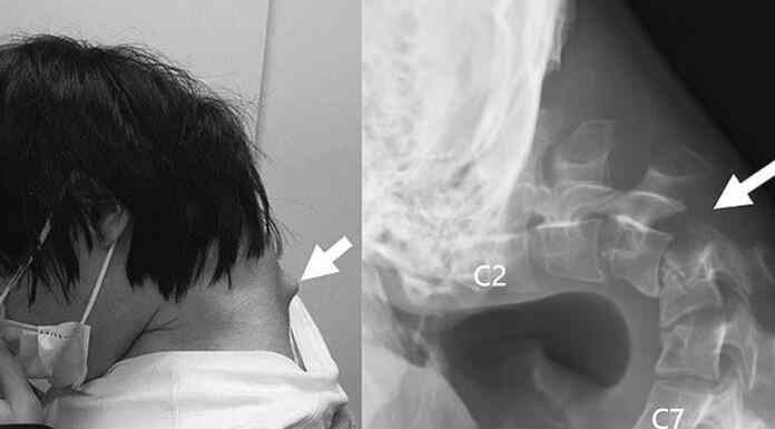 25χρονος Ιάπωνας gamer απέκτησε παραμόρφωση στον αυχένα- «σύνδρομο πτώσης κεφαλής» από την υπερβολική χρήση κινητού! 25χρονος Ιάπωνας gamer απέκτησε παραμόρφωση στον αυχένα- «σύνδρομο πτώσης κεφαλής» από την υπερβολική χρήση κινητού!