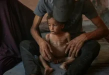 Γάζα: Ο ΠΟΥ προειδοποιεί – Χιλιάδες παιδιά κάτω των 5 ετών υποφέρουν από οξύ υποσιτισμό Γάζα: Ο ΠΟΥ προειδοποιεί – Χιλιάδες παιδιά κάτω των 5 ετών υποφέρουν από οξύ υποσιτισμό