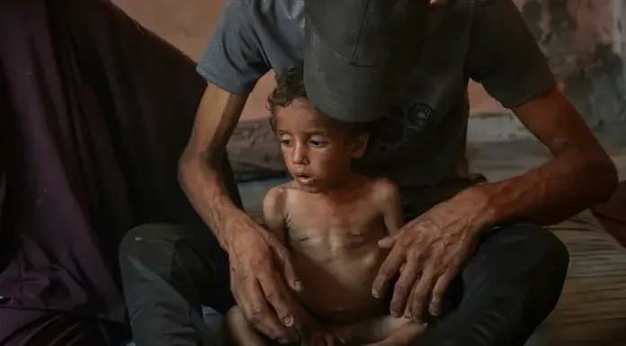 Γάζα: Ο ΠΟΥ προειδοποιεί – Χιλιάδες παιδιά κάτω των 5 ετών υποφέρουν από οξύ υποσιτισμό Γάζα: Ο ΠΟΥ προειδοποιεί – Χιλιάδες παιδιά κάτω των 5 ετών υποφέρουν από οξύ υποσιτισμό